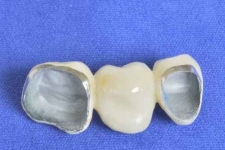 No pierdas tus muelas. Somos especialistas en coronas dentales y endodoncia en Mérida. 