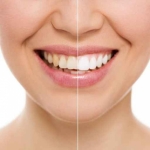 Luce unos dientes espectaculares. Limpieza y blanqueamiento dental en Mérida