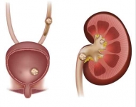 Atención Oportuna y Cirugía de Mínima Invasión en Pacientes con Litiasis (Piedras)