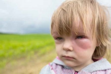 La picadura de Abeja o avispa, puede desencadenar reacciones muy severas si su origen es ALÉRGICO y no sólo por la toxicidad del piquete.
La alergia al piquete de abeja, avispa, hormiga y mosco, tiene tratamiento.
