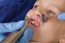 Dr. Guillermo Argáez: Especialista dental para niños. La higiene dental y servicios al cuidado de los niños en buenas manos. Ortodoncia para niños. Limpieza dental infantil, empastes dentales para niños y extracciones.