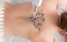 Eliminamos con láser, sin dolor, esos tatuajes que ya no te gustan