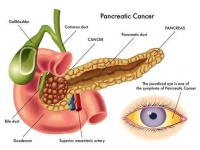 Especialista en cirugía por cáncer de páncreas