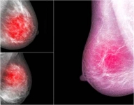 Especialista en cirugía por cáncer de mama (seno). Biopsia ganglio centinela.