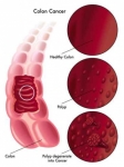 Cirugía por tumor maligno en colon e intestino delgado.