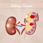 Especialista en cirugía por cáncer de riñón