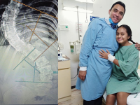 Paciente operada para corrección de escoliosis. Actualmente se encuentra con la columna restablecida.