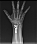 Atención especializada en el manejo de fracturas y luxaciones en extremidades, mediante manipulación e inmovilización o cirugía de la región afectada.
Urgencias ortopédicas las 24 hrs. en niños, adolescentes y adultos.
