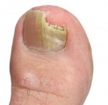 La onicomicosis es curable con un tratamiento eficaz y seguimiento adecuado por parte del paciente que lo padece. 
