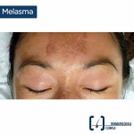 Las manchas en la cara son susceptibles de tratamiento para poder eliminarlas. Pida su cita con el Dr. Cervera