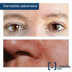 Tratamiento eficaz para eliminar la dermatosis seborreica
