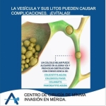 El dr. Rofolfo Aparicio le ofrece cirugía de mínima invasión para piedras de vesícula, en Mérida, Yucatán.