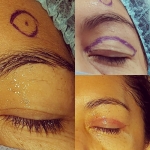La cirugía de párpados o blefaroplastia te hará lucir un rostro más joven, al eliminar el exceso de piel, músculo y grasa