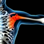 Atención oportuna por fracturas de articulaciones: fractura de hombro, fractura de rodilla, fractura de brazo, fractura de cadera, fractura de tobillo y fractura de pie.