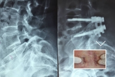 Paciente femenino de 62 años con canal lumbar estrecho secundario a inestabilidad L4-L5. Se le realizó instrumentación con tornillos y caja a través de vía mínimamente invasiva.