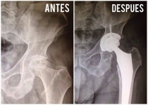 Paciente masculino de 65 años de edad con Necrosis Avascular de Cadera izquierda que tratamos con un Reemplazo Total de Cadera