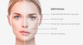Los síntomas más comunes de la parálisis facial son: lagrimeo, dificultad cerrar los párpados, visión borrosa, asimetría facial, dolor retroauricular, derrame de líquidos ingeridos, e hipersensibilidad a los sonidos cotidianos.