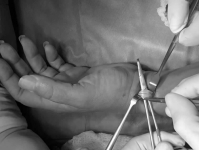 Cirugía para lesiones y cortes en tendones y ligamentos