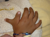 Cirugía para corrección de dedo extra, dedo más grande, ausencia de dedos, deformidades del antebrazo, mano zamba y sinostosis congénita
