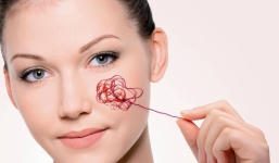 Las arañitas vasculares en la cara o telangectasias pueden ser tratadas y eliminadas por medio de escleroterapia; un procedimiento mínimamente invasivo y que te hará lucir un rostro joven.