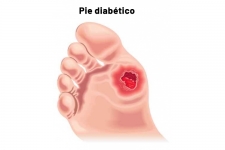 La Dra. Elena Solís es experta en manejo y curación de pie diabético, heridas crónicas y gangrena (muerte del tejido corporal).