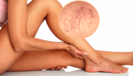 Las arañitas vasculares o telangectasias con comunes en las piernas y cara y pueden ser tratadas y eliminadas por medio de escleroterapia; un procedimiento mínimamente invasivo que te hará lucir unas bellas piernas.