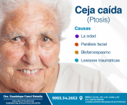 Cirugía de ptosis palbebral que consiste en el levantamiento de párpados caídos.